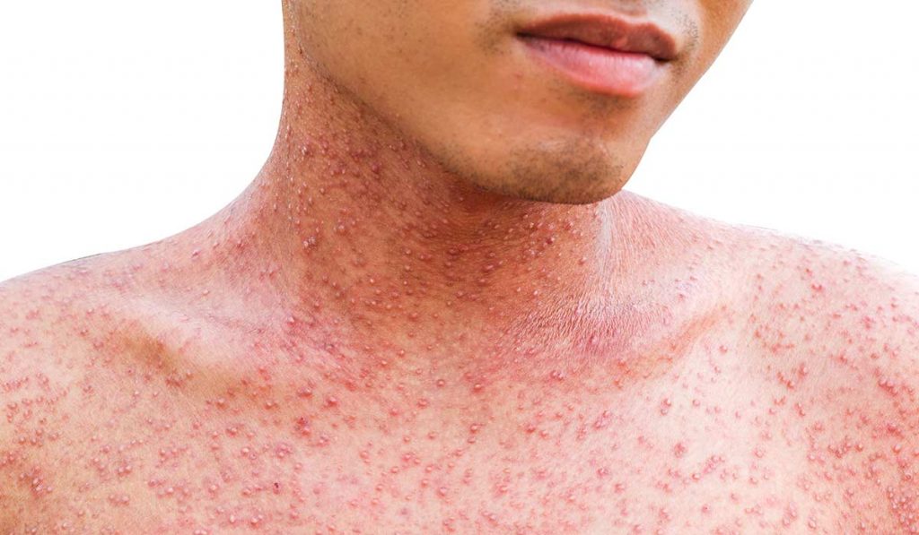 Гродзенцам рэкамендуюць зрабіць прышчэпку ад адзёру